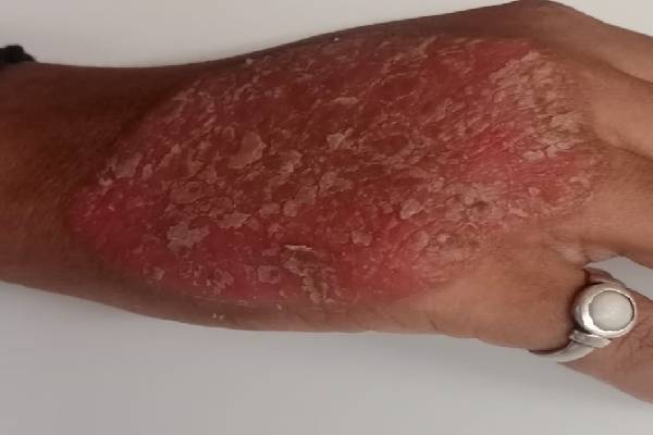 Psoriasis Case Image 1