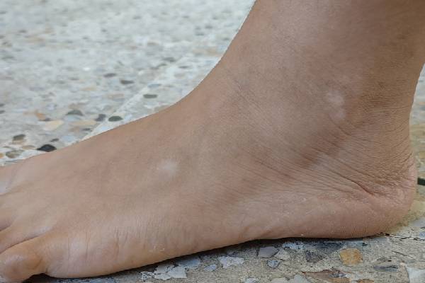 Vitiligo Image 6