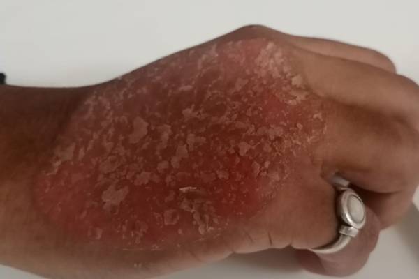 Psoriasis Case Image 2