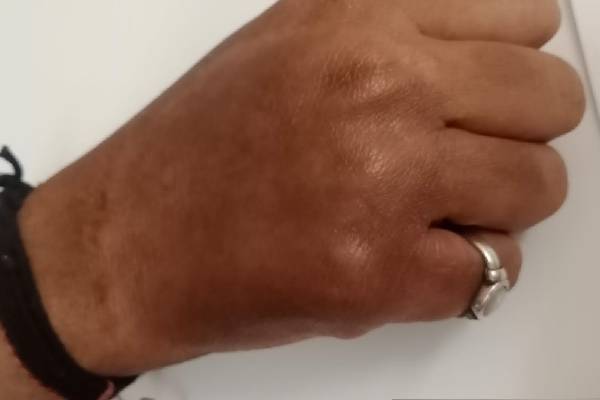Psoriasis Case Image 3