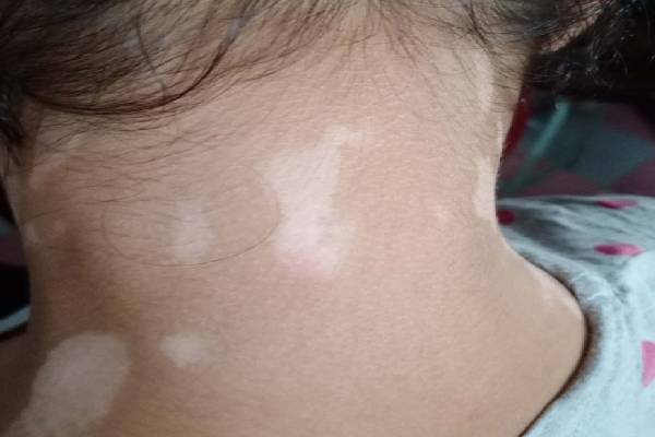 Vitiligo Image 2