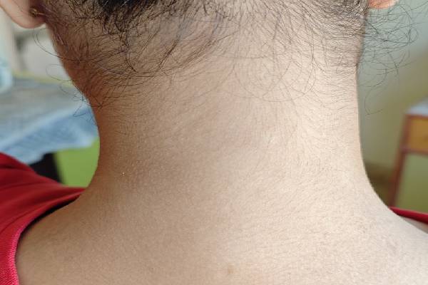 Vitiligo Image 3