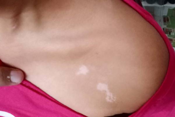 Vitiligo Image 4