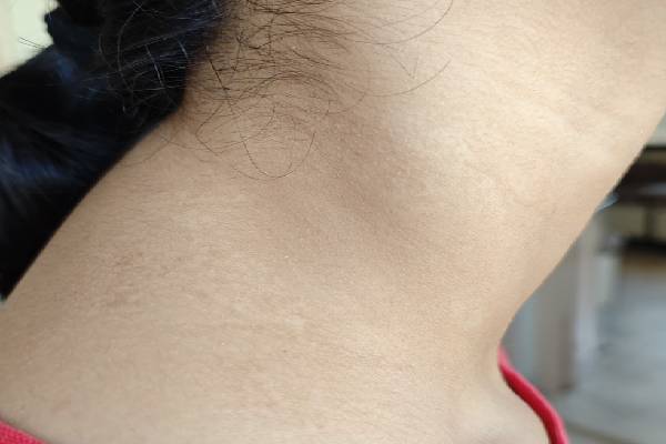 Vitiligo Image 5