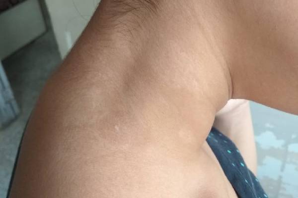 Vitiligo Image 6